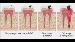 Stages of Tooth Decay Introduction [upl. by Adaran]