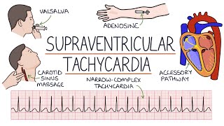 Ventricular Septal Defect VSD [upl. by Alios]