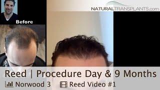 Norwood 3 Hair Transplant Surgery Day amp 9Month Followup Dr Matt Huebner Reed [upl. by Attah]