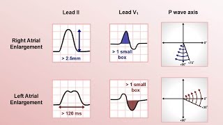 Hypertrophic Cardiomyopathy Parasternal Long Axis Echocardiogram View [upl. by Onailil]