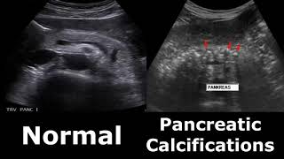 Pancreas Ultrasound Normal Vs Abnormal Appearances Comparison Pancreas Pathologies On Ultrasound [upl. by Ahtamas]