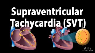 Supraventricular Tachycardia SVT PSVT Animation [upl. by Hans]