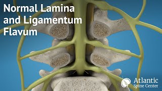 Normal Lamina and Ligamentum Flavum [upl. by Albie490]