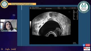 Managing Hydrosalpinx before IVF [upl. by Elissa563]