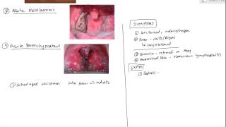 Tonsilitis [upl. by Enrica128]