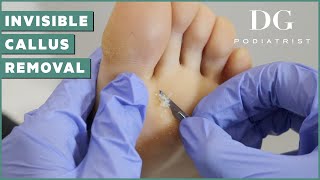 Callus removal from feet a young yoga instructor  The Foot Scraper DG Podiatrist [upl. by Qirat96]