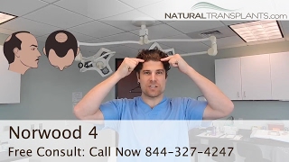 Norwood 4  Norwood Men’s Hair Loss Scale [upl. by Ney]