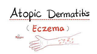 How to treat Eczema Dermatitis  Doctor Explains [upl. by Alba814]