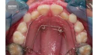 Morphing  Orthodontic maxillary expansion with Quad Helix [upl. by Tracay]