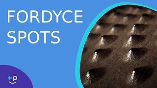 Fordyce Spots Oil Glands or Warts [upl. by Neerol434]