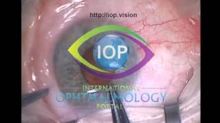 Upper GI Endoscopy Procedure in the ED [upl. by Aida907]