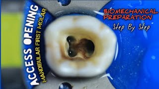 Access Opening Mandibular First Molar  Biomechanical Preparation  step by step [upl. by Scevour]