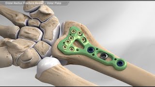 Distal Radius Fracture Repair  Volar Plate [upl. by Sire]