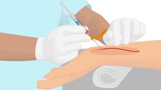 How to properly handle an arterial puncture blood gas sample [upl. by Isiad]