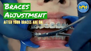 How Do Braces Straighten Teeth [upl. by Ihel]