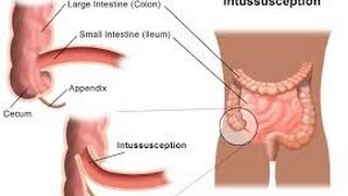 Intussusception [upl. by Willet271]