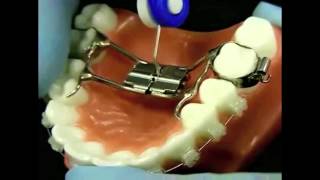 Palatal Expander with Hildebrand Orthodontics [upl. by Dimitris]