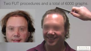 6Month Hair Transplant Update  Adrian Brown Australia [upl. by Accever649]