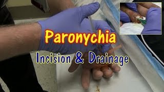 Paronychia Incision and Drainage [upl. by Abe]