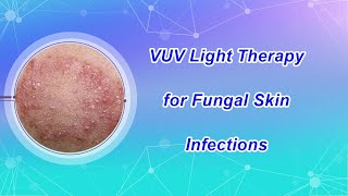 VUV Light Therapy for Fungal Skin Infections [upl. by King]