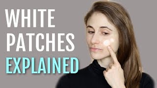 WHITE PATCHES ON THE FACE EXPLAINED PITYRIASIS ALBA DR DRAY [upl. by Aural652]