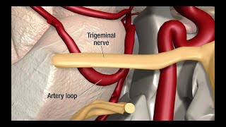 Treatment for Trigeminal Neuralgia UCSF Neurosurgery [upl. by Marika]