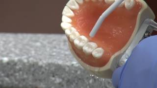 New cavity treatment offers no drilling no filling [upl. by Syst786]