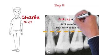 The new periodontal classification MUST WATCH FOR ALL DENTISTS [upl. by Drageruaeb382]