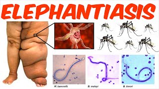 Lymphatic Filariasis  Elephantiasis [upl. by Eelir595]