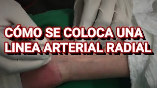 LINEA ARTERIAL RADIAL  COMO COLOCAR [upl. by Rahman]