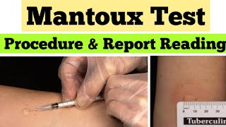 Mantoux Test in Hindi  Tuberculin Skin Test  mantoux test results reading [upl. by Kiyohara789]