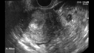 EMBARAZO ECTÓPICO SIGNOS Y SÍNTOMAS ECOGRAFÍA DE EMBARAZO ECTÓPICO [upl. by Simmie]