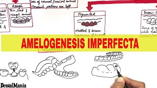 Amelogenesis Imperfecta  Pathogenesis Types Clinical features and Treatment [upl. by Ayortal]