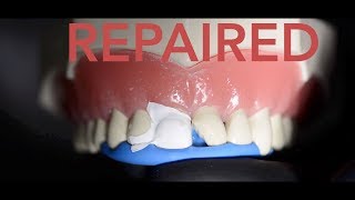 How the dentist repairs a chipped tooth [upl. by Nylecyoj]