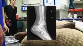 Ankle Fracture Dislocation Reduction [upl. by Saalocin]