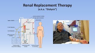 Acute Kidney Injury Part 33  Treatment and Complications [upl. by Abbe]