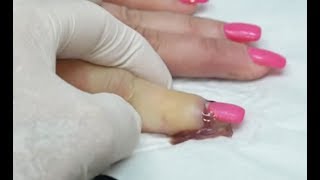 Worst Nail Infections of All Time Paronychia [upl. by Nanine]