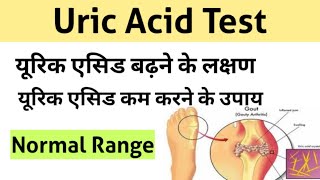 Uric Acid Test in Hindi  uric acid treatment  uric acid symptoms [upl. by Sualocin536]