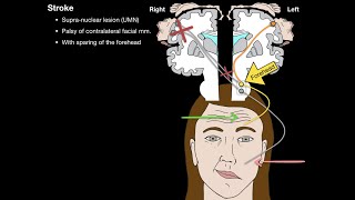 Bells Palsy and Stroke [upl. by Ahseki]