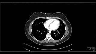 Abdominal Anatomy on Computed Tomography [upl. by Eenwahs]