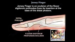 Jersey Finger  Everything You Need To Know  Dr Nabil Ebraheim [upl. by Rennoc788]