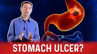 What is Gastritis  The GutDr Explains 3D Gut Animation [upl. by Anuahsal]