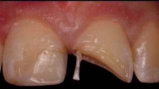 Rebuilding a Fractured Tooth with Pins [upl. by Thurber]