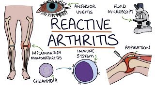 Understanding Reactive Arthritis [upl. by Eisenhart]