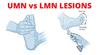 UMN vs LMN Lesion [upl. by Airtemed365]