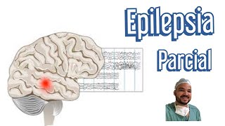 Crise Focal Epilepsia [upl. by Gustave771]