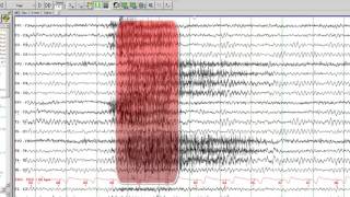 EEG in Juvenile Myoclonic Epilepsy [upl. by Vaasta633]