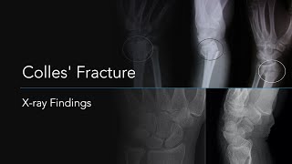 Colles Fracture Xray Findings [upl. by Tada]