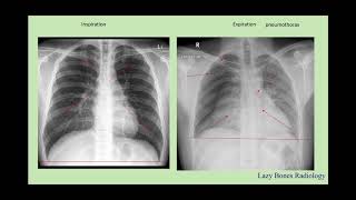 Body Cavities abdominal divisions and body habitus episode 3 LazyBonesRadiology [upl. by Kcirdaed]