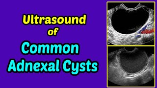 What You Need to Know About Ovarian Cysts [upl. by Eiznil]